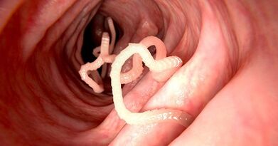 Die Ursachen von Parasiten im menschlichen Körper