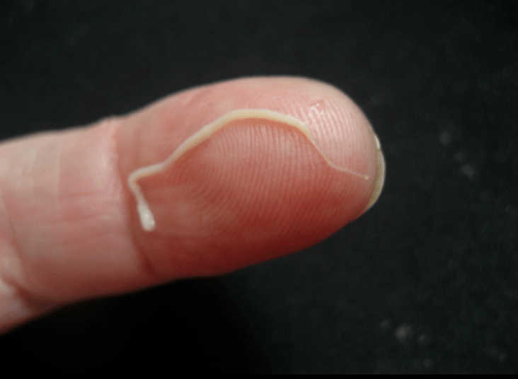 Spulwurmparasit aus dem menschlichen Körper